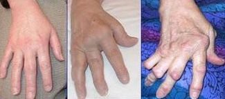Arthritis