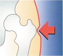 Hip Protectors 1