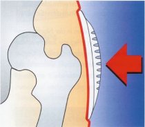 Hip Protectors 2